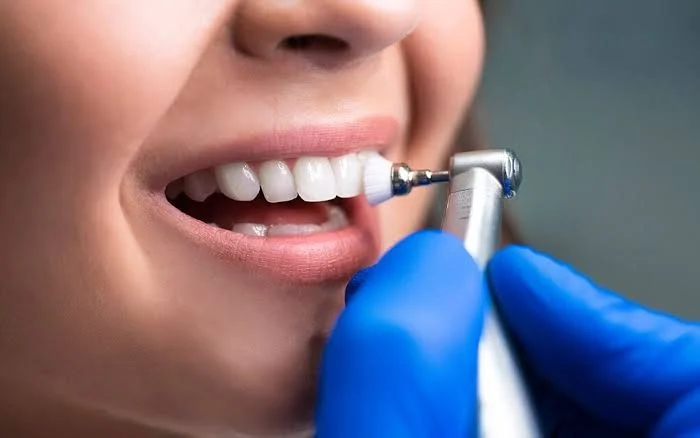 ¿Cada cuánto tiempo hay que hacerse una limpieza dental?